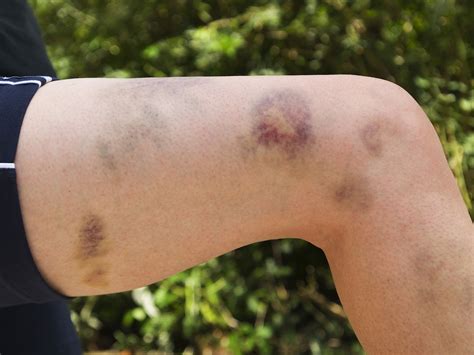 Then I noticed 2-3 <b>bruises</b> <b>on</b> <b>her</b> upper thighs, inside area, up high. . What does it mean when a girl has bruises on her legs